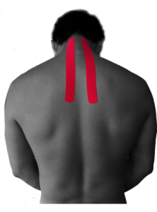 Kinesio_Tape_Posterior_neck_pain